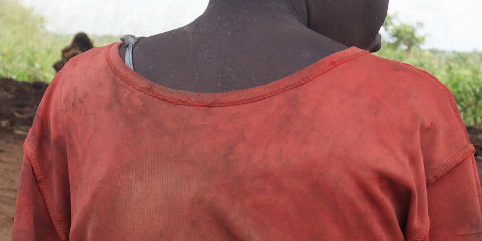 01_GPJNews_Uganda_PL_NoddingSyndrome_028_L copy