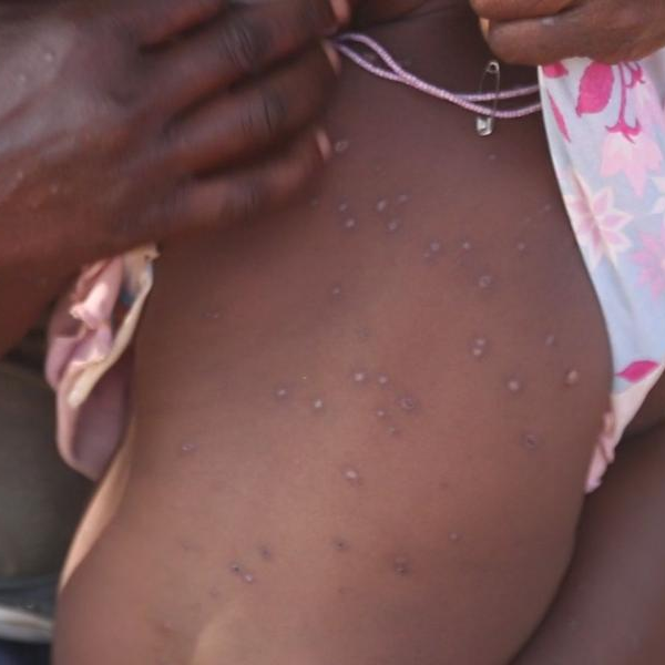 A mother and the child all affected by the strange skin disease